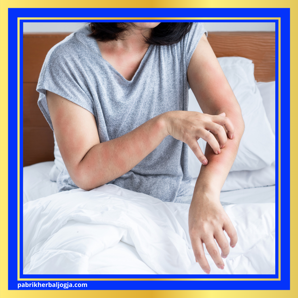 Atasi Alergi dengan Herbal Alami