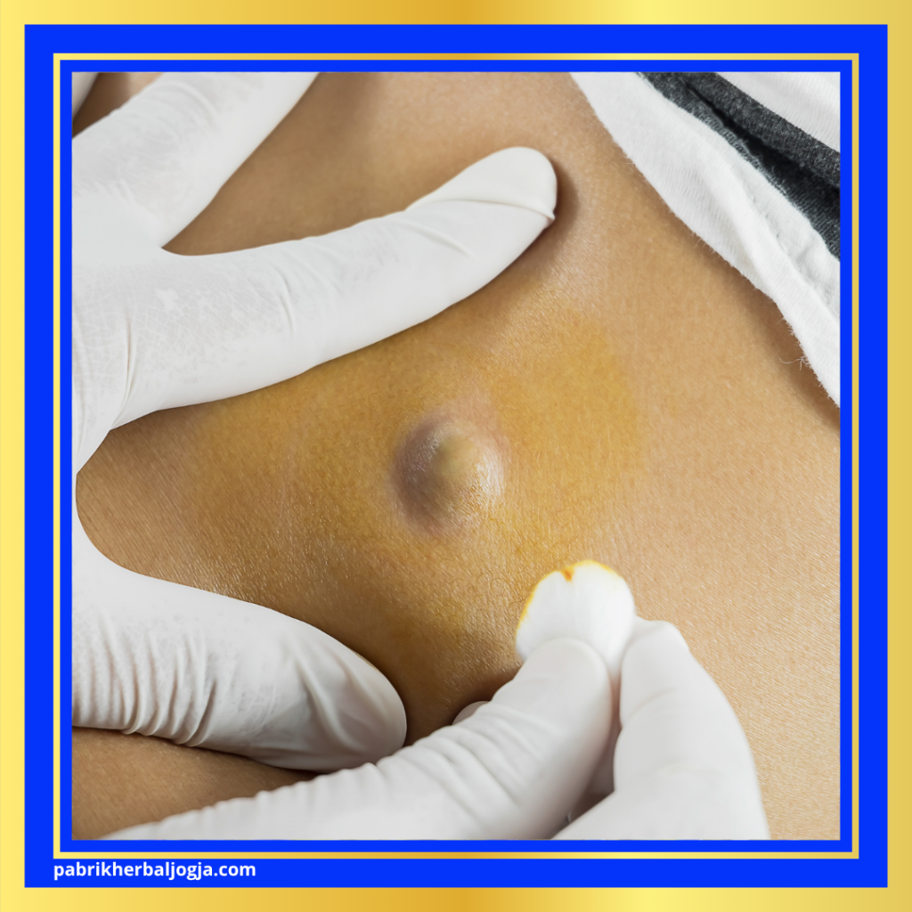 Jenis Penyakit Kista