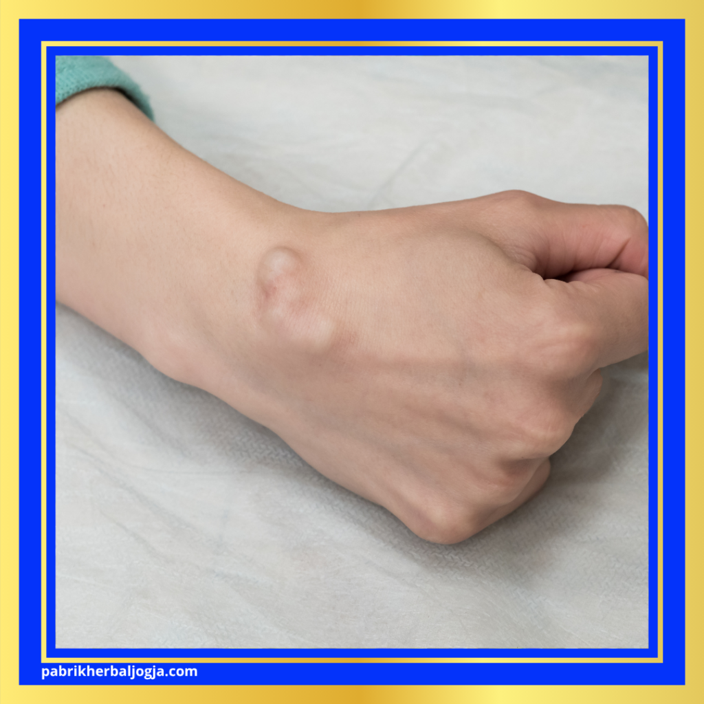 Jenis Penyakit Kista