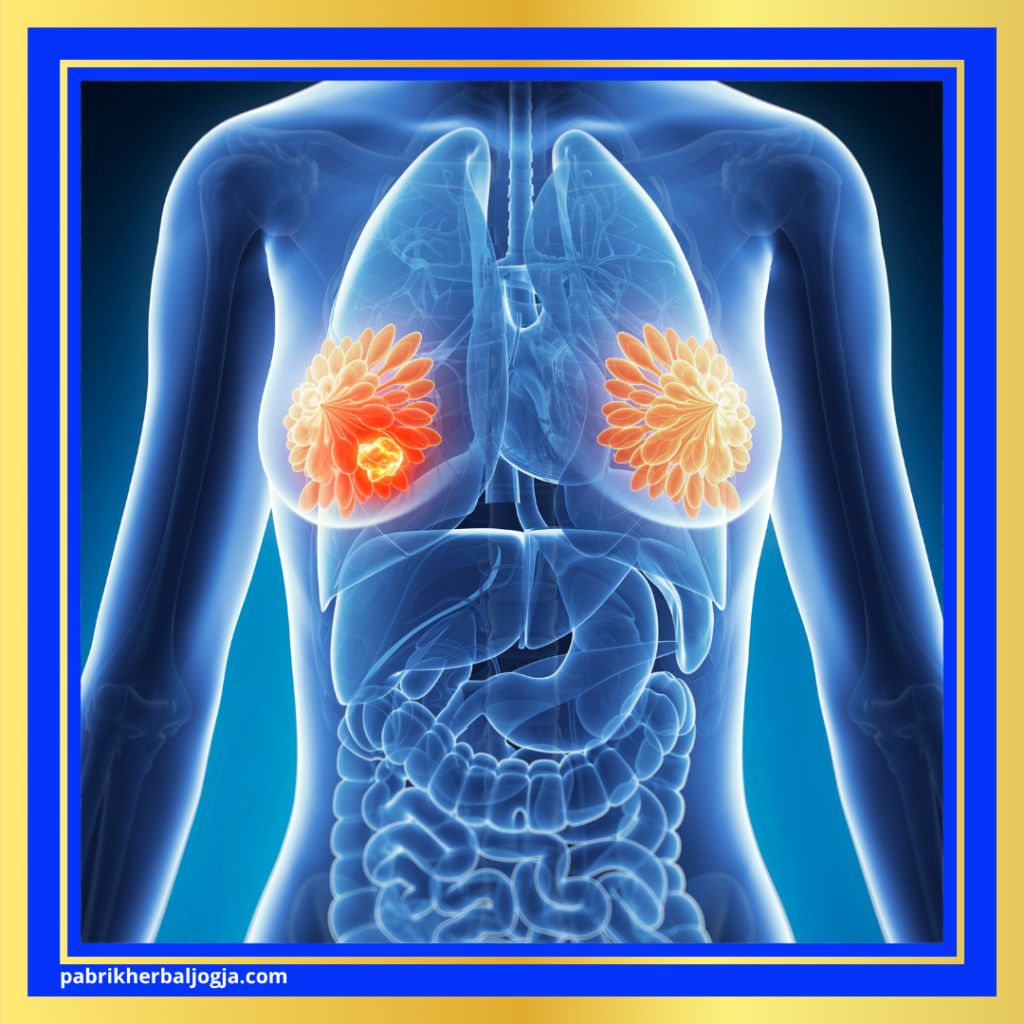 Jenis Penyakit Kista