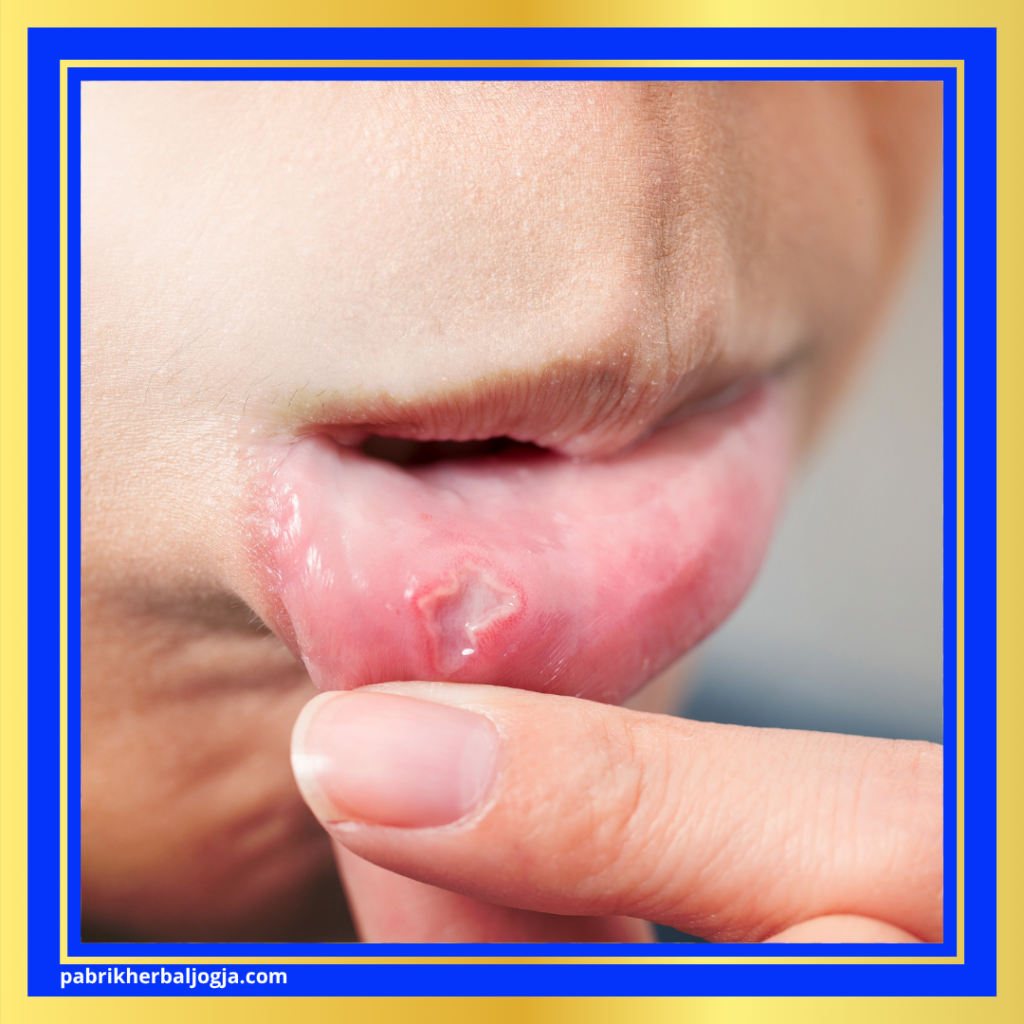 Gejala Penyakit Autoimun