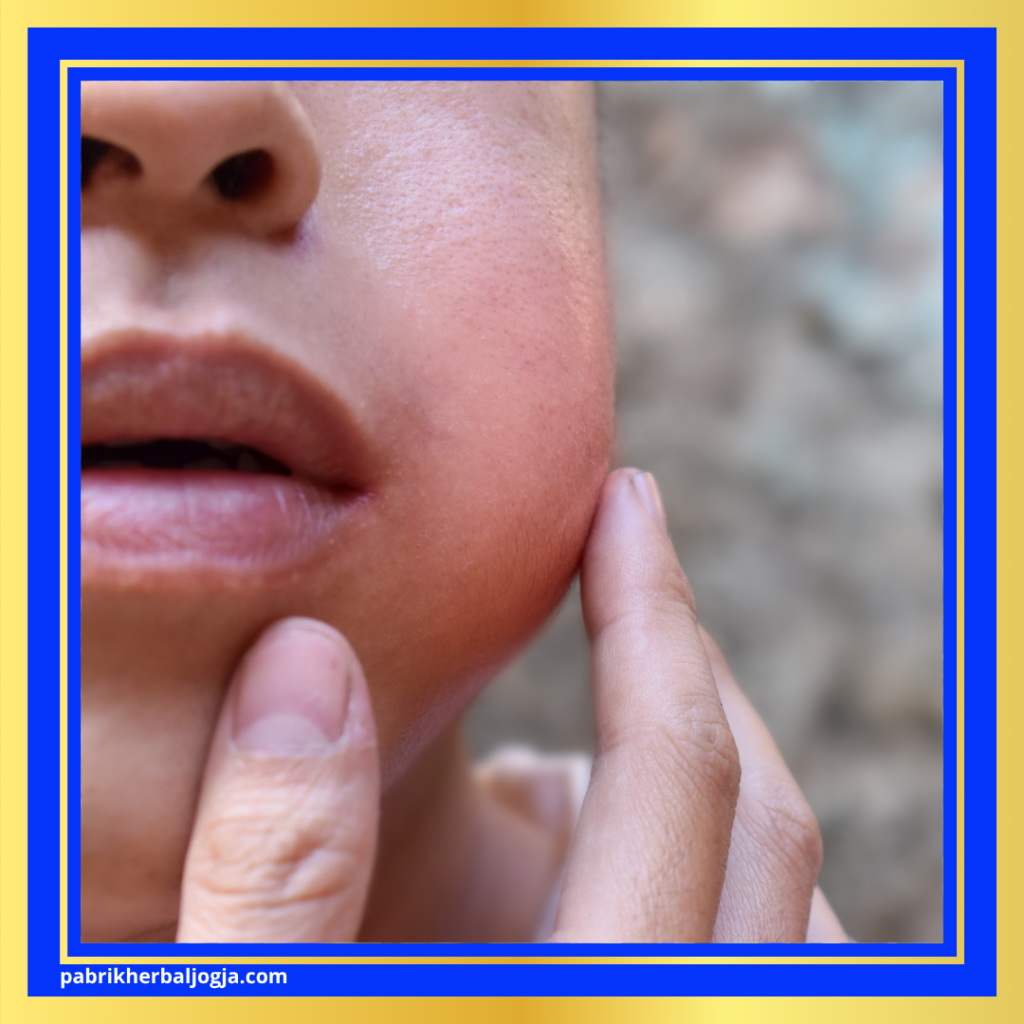 Cara Alami Mengatasi Gondongan