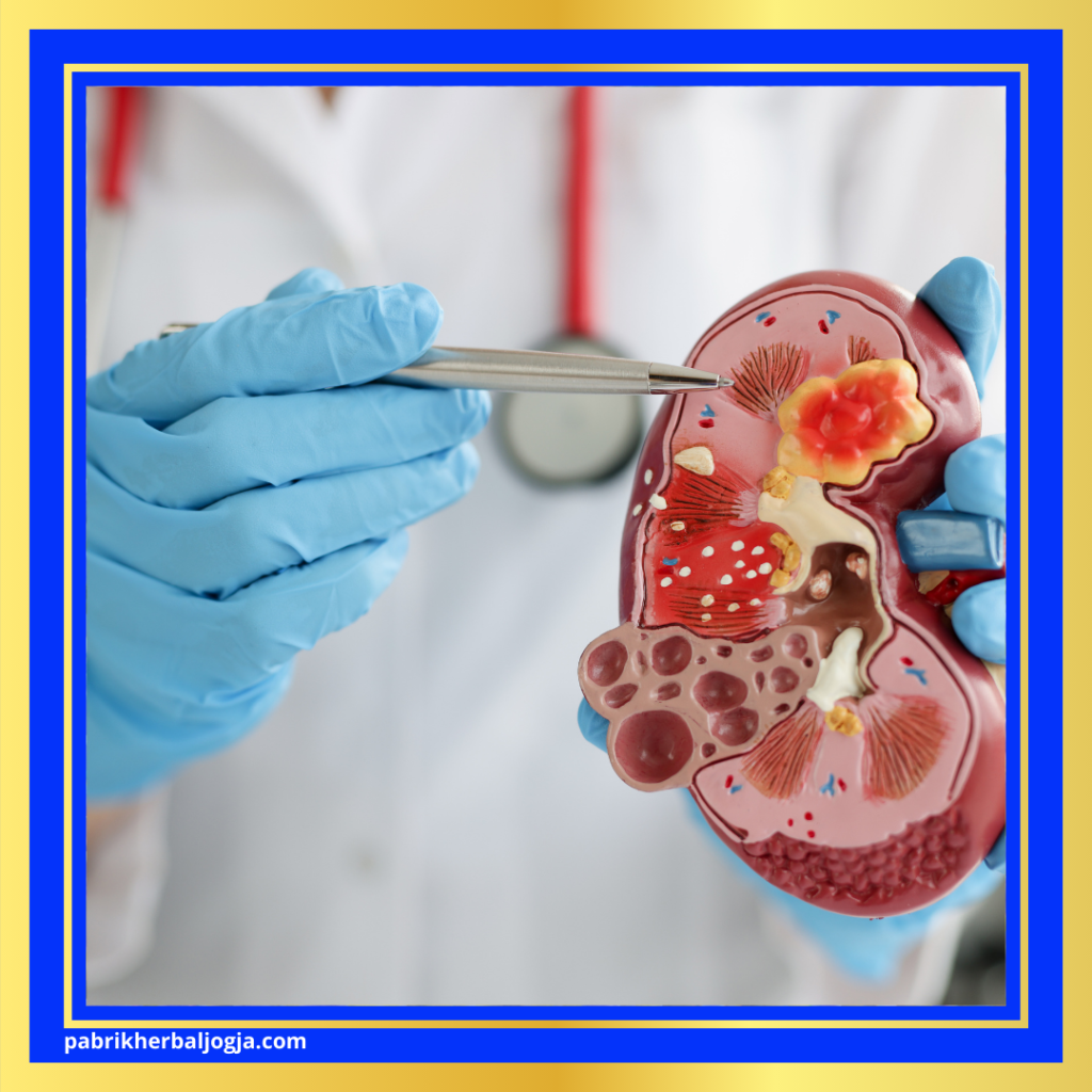 Penyebab Batu Ginjal